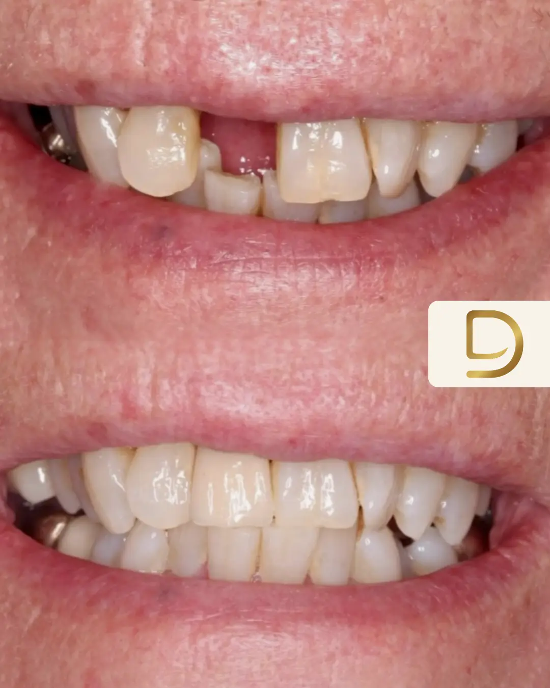 Single tooth dental implant at Lye Dental