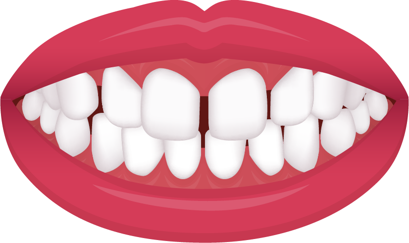 Gaps illustration