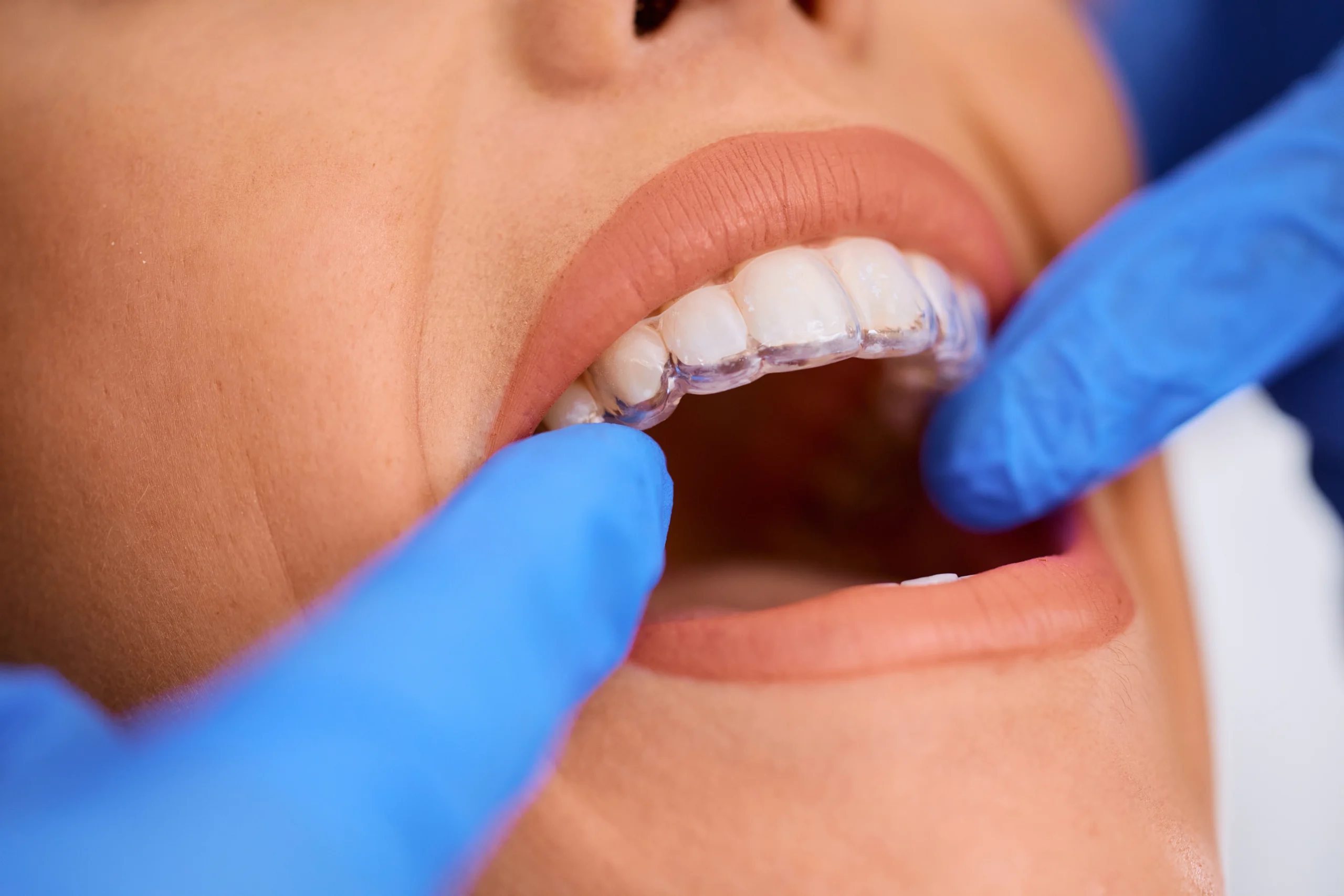 You wear and swap, at Lye Dental