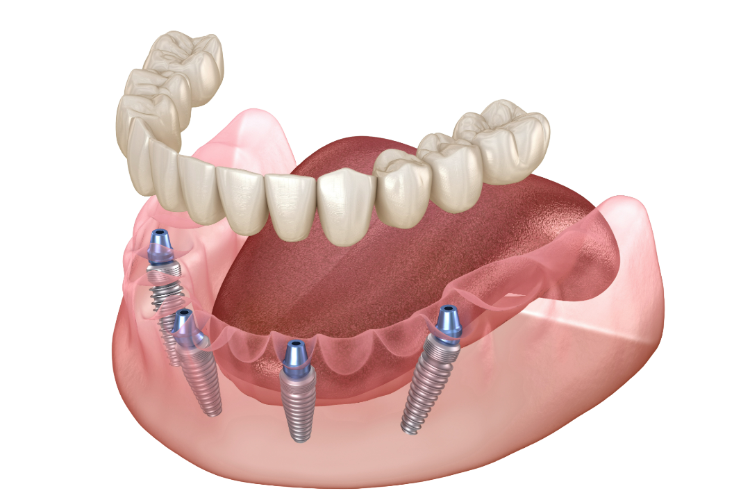 All-on-4 implant diagram
