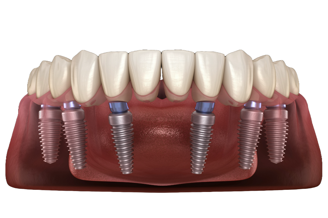 All-on-6 implant diagram