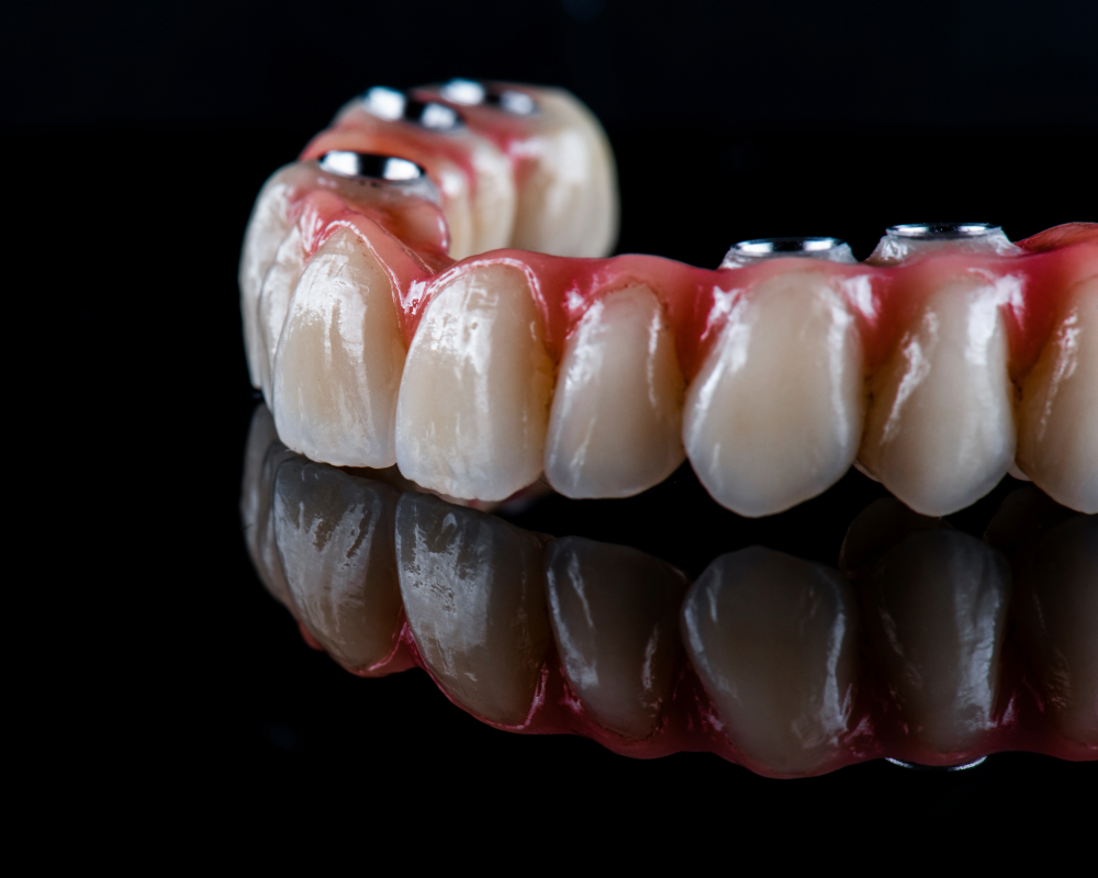 All-on-4 full arch implants at Lye Dental