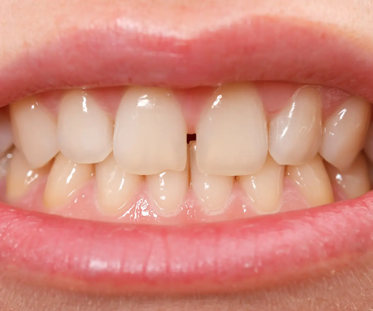 Gaps