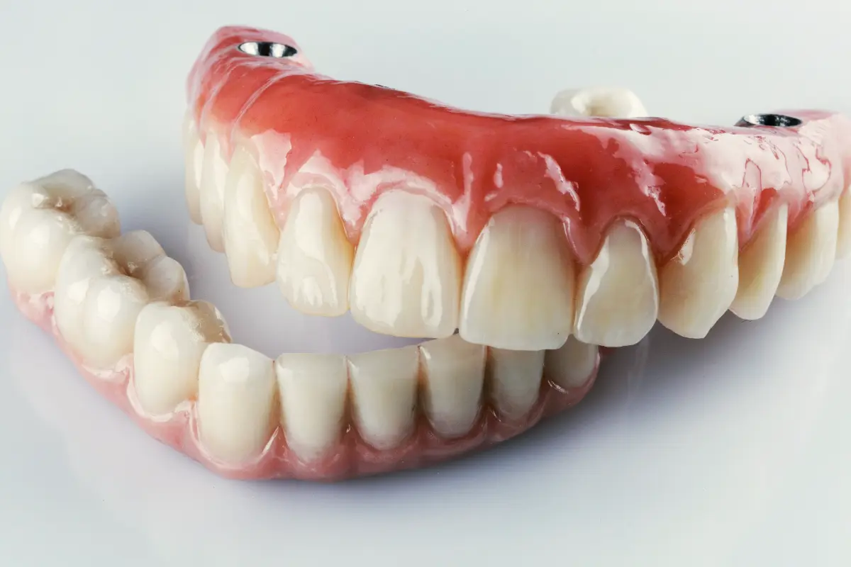 Implant-retained dentures