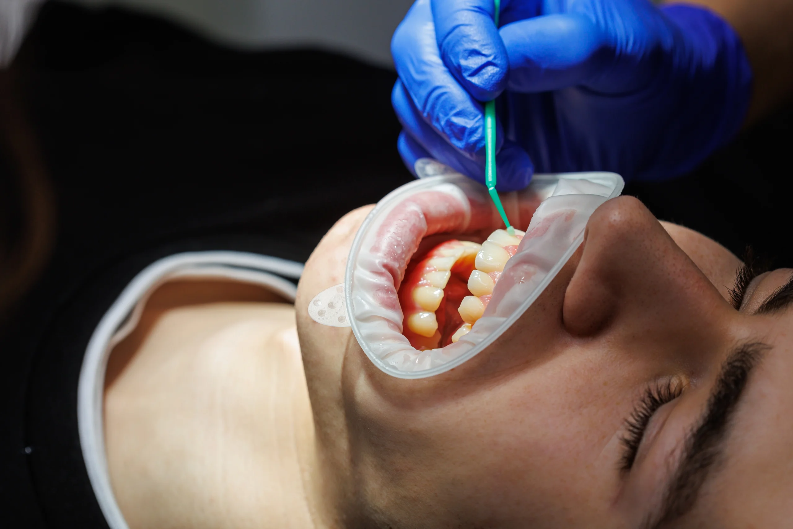 We shape the resin, at Lye Dental