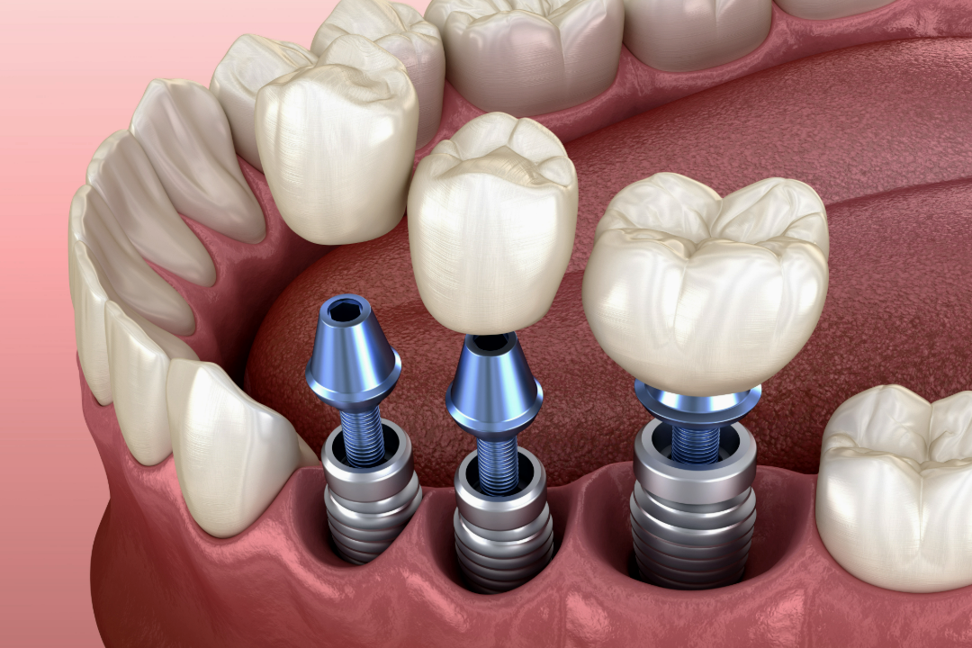 Implant bridge replacing multiple teeth at Lye Dental