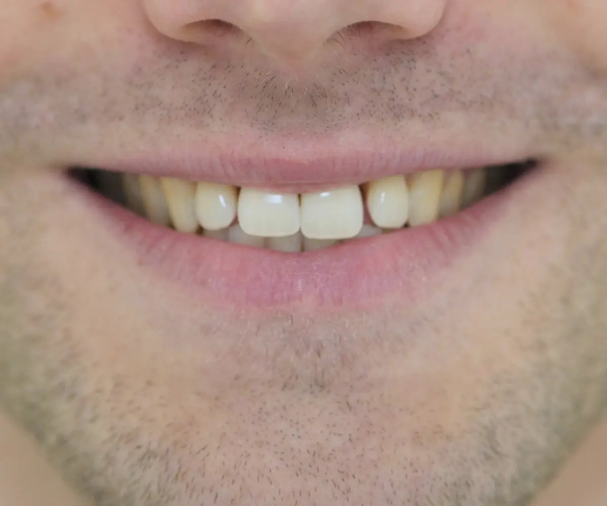 An uneven smile line