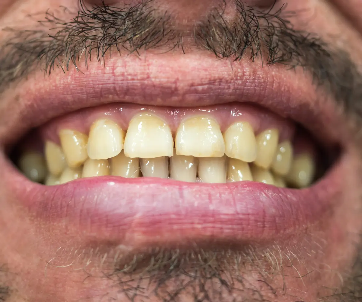 Worn or uneven teeth